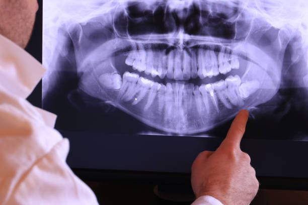 Best Emergency Wisdom Tooth Extraction in Pomona, NY